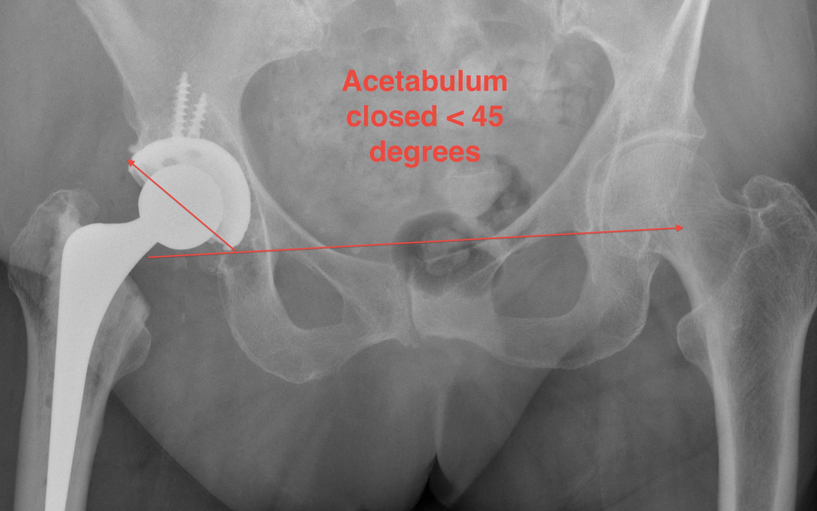 THR Acetabulum Closed < 45 degrees